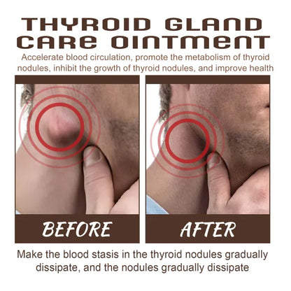 South Moon Thyroid Gland Ointment Cream ( BUY 1 GET 1 FREE )